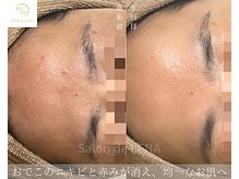 サロンドレナ 名駅店/ハーブピーリング サロンドレナ