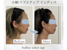 アピ(api)/症例写真【小顔インディバ】