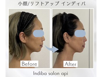 アピ(api)/症例写真【小顔インディバ】