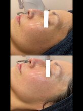 ディオーネ 春日井勝川店(Dione)/マーメイドセルトリートメント