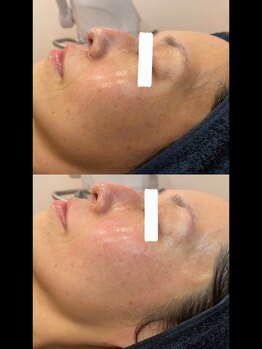 ディオーネ 春日井勝川店(Dione)/マーメイドセルトリートメント