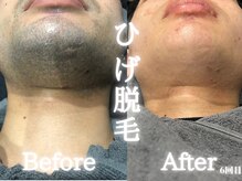 イデアル(ideal)の雰囲気（ひげ脱毛で毎日ひげ剃りから解放☆）