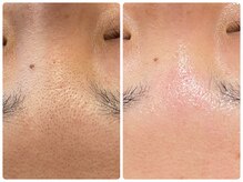 ラヴィ(Ravi)/Tゾーンの毛穴ケア