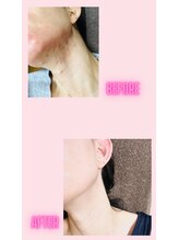 ヨサパーク エルメ 経堂(YOSA PARK Herme)/ルルオンで美肌になれる