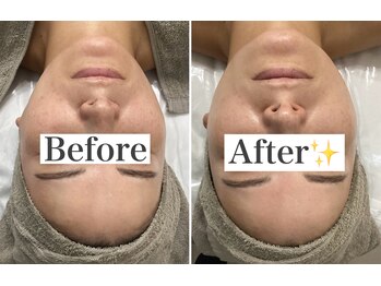 ホリシア 博多(HORISHIA)/ララピール/毛穴/ニキビケア