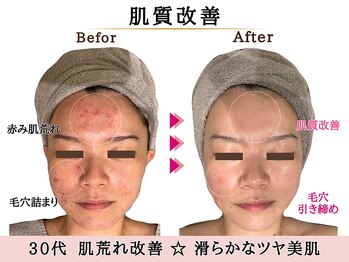 グレースエール トータルビューティーサロン(Grace Aile)/肌質改善