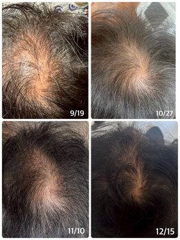 クリスタルグロウ 苫小牧大町店(Crystal Glow)/CURAIM育毛促施術