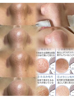 エイナミ/毛穴洗浄【黒ずみ毛穴集中ケア