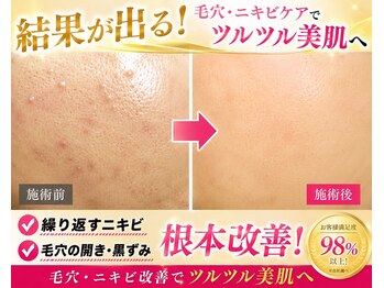 サロンドエステケイワイ(de KY)の写真/圧倒的お肌の変化!人気のダイヤモンドピーリング&イオン導入!ニキビケア/毛穴/古い角質/凸凹/敏感肌も◎