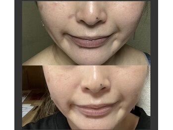 アイビークイーン(I.B.QUEEN)/光フェイシャルでぱっと明るい肌