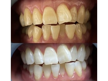 カドゥルエクラ(Cuddleclat)/ホワイトニング　Before→After