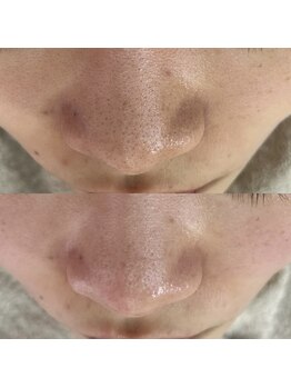 スイ 四条烏丸(SUI)/〇毛穴洗浄