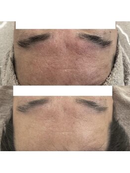 ヴェルシック(Belchic)/剥けない国産ハーブで赤ら顔改善