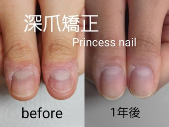 プリンセスネイル(Princess nail)/深爪矯正1年、美親指