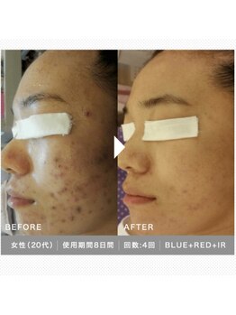 ティアーナ(Tiaana)/LED　４回