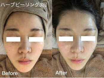 プティ 横浜店(Petit)/毛穴/赤みに◎ハーブピーリング