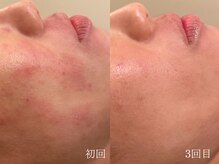 ウォーム(warm)/【肌質改善専門店warm】毛穴洗浄