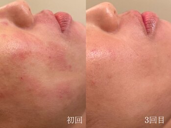 ウォーム(warm)/【肌質改善専門店warm】毛穴洗浄