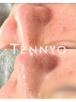 リュミエール デスポワール(Lumiere d'espoir)/毛穴洗浄