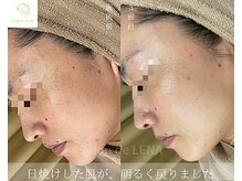 サロンドレナ 名駅店/ハーブピーリング サロンドレナ