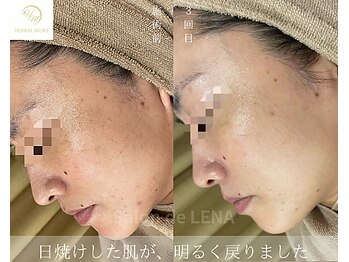 サロンドレナ 名駅店/ハーブピーリング サロンドレナ