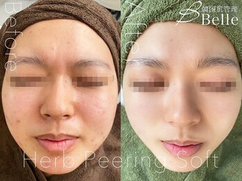 【毛穴|ハーブピーリング】韓国肌管理Belle 姫路/ハーブピーリング|ニキビケア