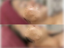 GRACETHOUSAND(グレイスサウザンド)/ハーブピーリング/洗浄/シミケア