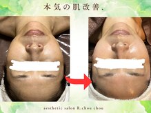 アール シュシュ(R.chouchou)/本気の肌改善ガリレオピーリング