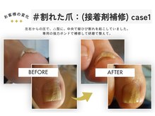 テネシー/＃割れた爪：(接着剤補修) case1
