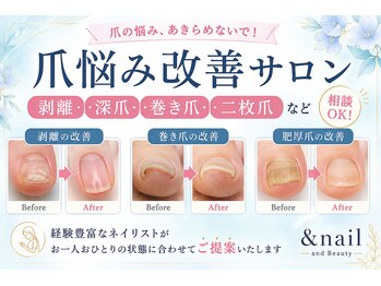 アンドネイルアンドビューティー(&NAIL and Beauty)の写真/爪の剥離・深爪・巻き爪など爪悩み改善の専門オーナーネイリスト監修サロン