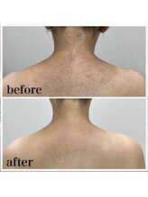 ラクシー 御徒町(luxssy)/背中シェービング