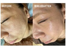 フィズ 府中店(FIS)/☆ハーブピーリング☆都度払い 