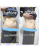 カナウ(Kanau)/脂肪冷却