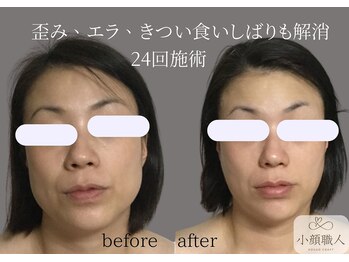 小顔職人/ 小顔ビフォーアフター/40代