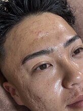 ウミ(Ummi)/ハーブピーリング