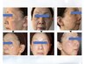 【発光美白】ホワイトスノーピール６回コース