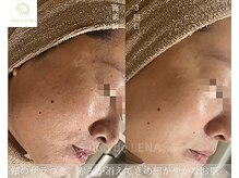 サロンドレナ 名駅店/ハーブピーリング サロンドレナ