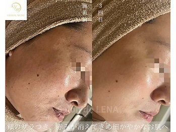 サロンドレナ 名駅店/ハーブピーリング サロンドレナ