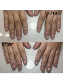 深爪矯正★軽度