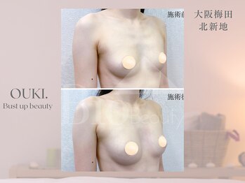 【育乳・バスト専門×女性らしさを磨く】OUKI. 梅田北新地【3月1日 OPEN（予定）】/バスト結果写真