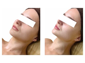 スカイアンドシー(sky&sea)の写真/比べてみて！「ここでしか体験できない」最先端マシン×プロの施術◎人にお披露目したくなる美肌へ♪