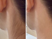 リバース(waxR B S)の雰囲気(うなじダブル脱毛で成人式/結婚式/パーティでのアップヘアに◎)