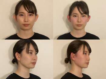 フラット(FURATTO)/Before - After【施術回数3回】