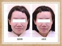 ビキュール 表参道店(美cuol)/フェイスラインすっきり！