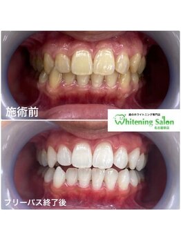 ホワイトニングサロン 名古屋駅店/【ホワイトニング施術例】