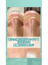 ネクサス(NEXUS)/【毛穴ケア】お客様の声30代女性