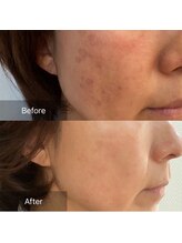 リュミエール(umiere)/たるみケア・シミ改善に◎