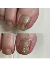 リリ(lili)/巻き爪矯正/2回目