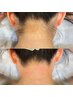 【wax脱毛】うなじwax