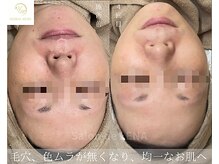 サロンドレナ 名駅店/ハーブピーリング サロンドレナ